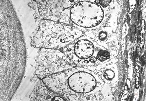 M,46y. | prostate - residual lysosomes